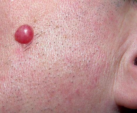 Borrelioosin aiheuttama kyhmy korvalehdessä, nännissä tai kiveksissä: Näin se näyttää. 5