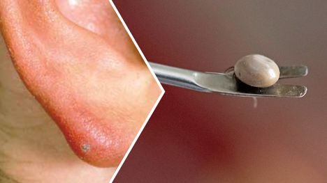 Borrelioosin aiheuttama kyhmy korvalehdessä, nännissä tai kiveksissä: Näin se näyttää. 1